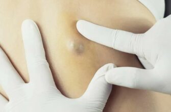 Абсцес: визначення, причини появи та методи лікування.