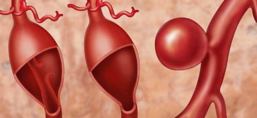 Загроза аневризми: що це таке, симптоми, причини та лікування