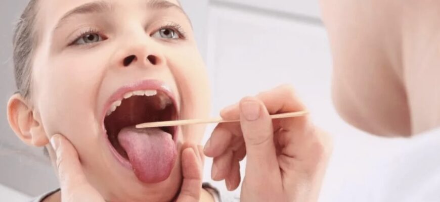 Що таке ангіна: основні симптоми, причини та ефективні методи лікування