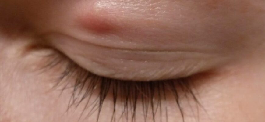 Атерома: Причини виникнення, симптоми та методи лікування