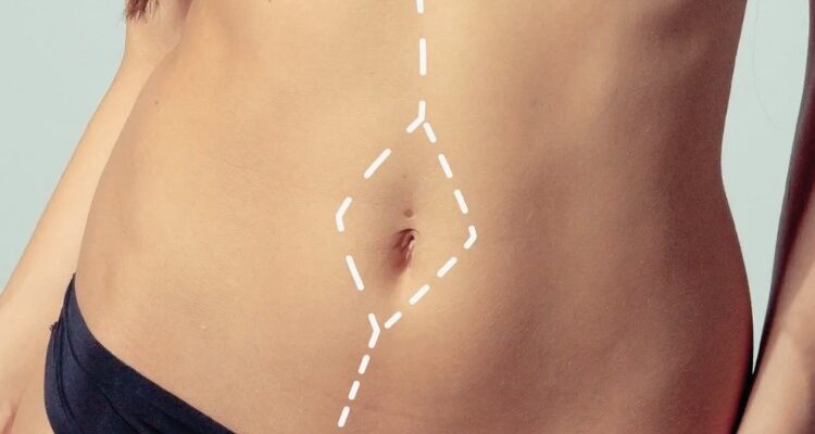 Діастаза: причини, лікування та запобігання розходженню м’язів живота