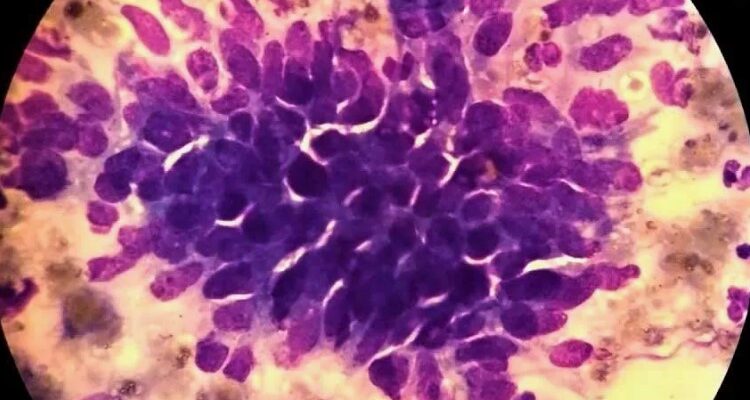 Дисплазія: визначення, симптоми та методи лікування захворювання