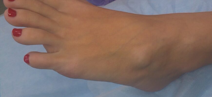 Що таке гігрома: причини, симптоми та методи лікування