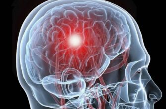 Інсульт: основні причини, симптоми та методи профілактики