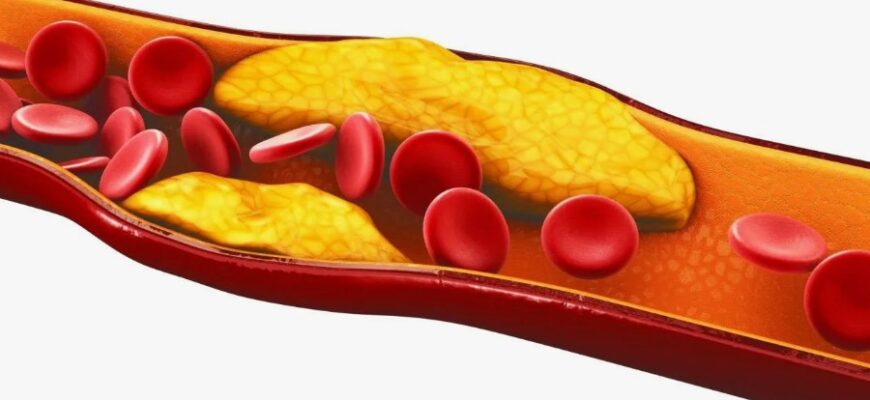 Холестерин: Визначення, Види та Вплив на Здоров’я Людини