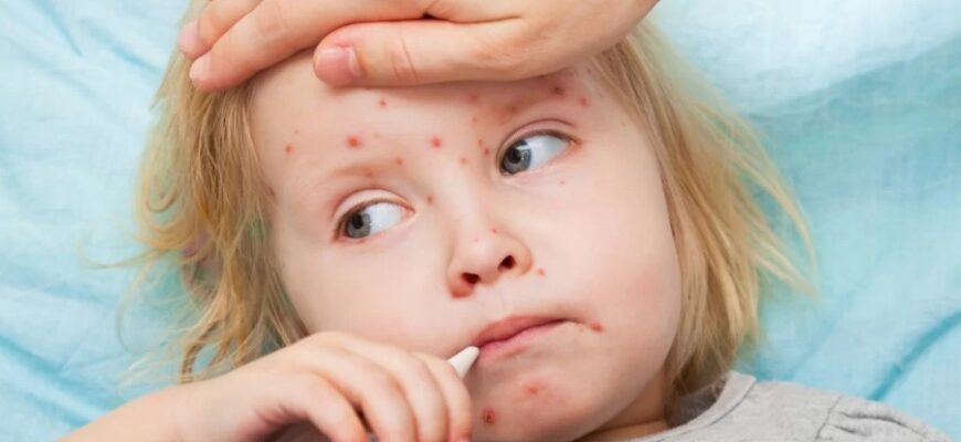 Кір: Симптоми, Причини та Профілактика Вірусного Захворювання