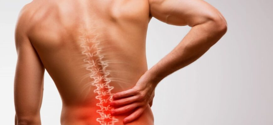 Радикуліт: Визначення, симптоми та ефективні методи лікування