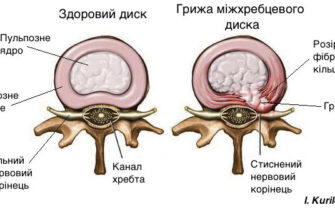 Остеофіти: Причини виникнення, симптоми та методи лікування
