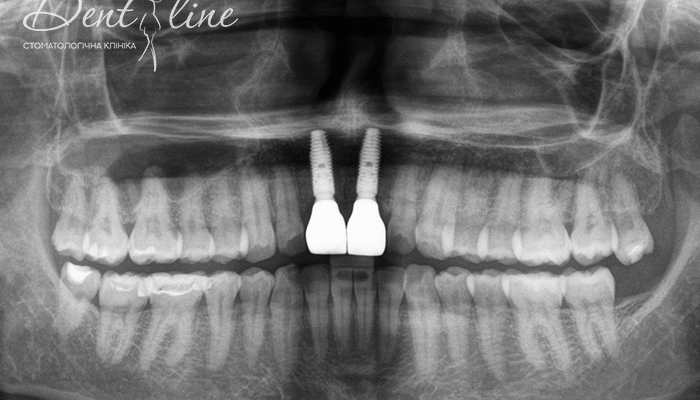 Резорбція: що це таке і як відбувається в тілі людини?