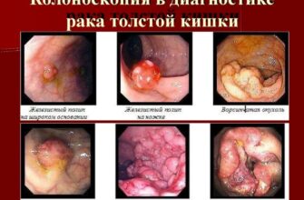 Ректороманоскопія і колоноскопія: у чому різниця між обстеженнями?
