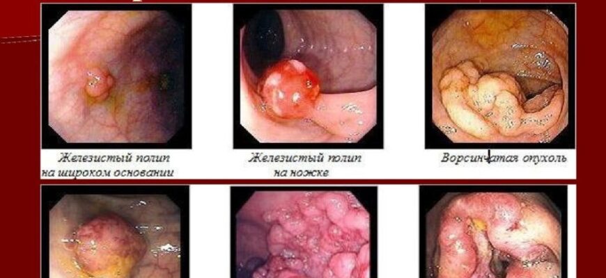 Ректороманоскопія і колоноскопія: у чому різниця між обстеженнями?