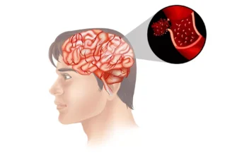Інсульт: основні причини, симптоми та методи запобігання хворобі