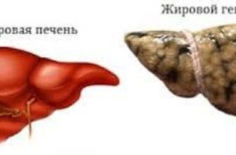 Жировий гепатоз: симптоми, причини та методи лікування захворювання