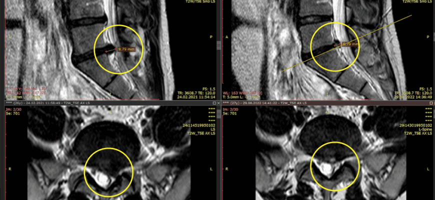 Люмбоішіалгія: симптоми, причини та ефективні методи лікування
