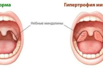Аденоїди і гланди: у чому різниця та як розпізнати симптоми?