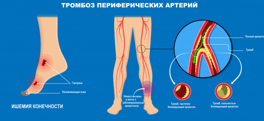 Гангрена: Причини, Симптоми та Методи Лікування Цієї Небезпечної Недуги