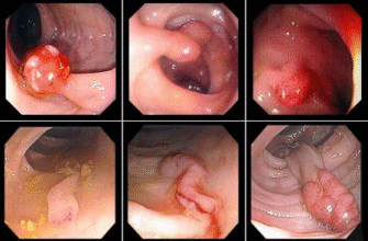 Фіброколоноскопія vs Колоноскопія: В Чому Полягає Різниця?
