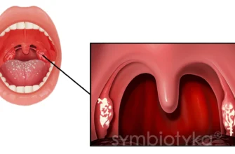 Причини, симптоми та лікування ангіни як вірусного захворювання