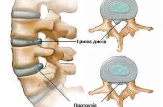 Протрузія і грижа: ключові відмінності та важливі аспекти