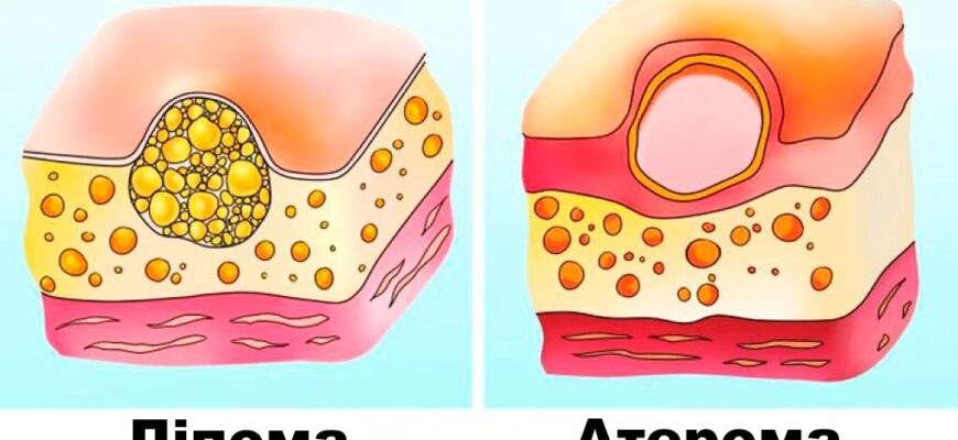 Ліпома та атерома: у чому різниця та як їх розпізнати?