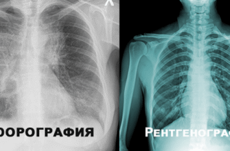 “Флюорографія і рентген: у чому різниця і що обрати для діагностики?”