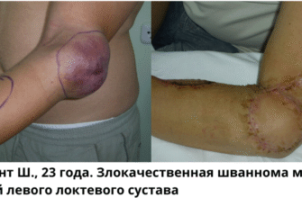 Рак і саркома: різниця, симптоми та методи лікування захворювань