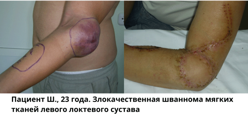 Рак і саркома: різниця, симптоми та методи лікування захворювань