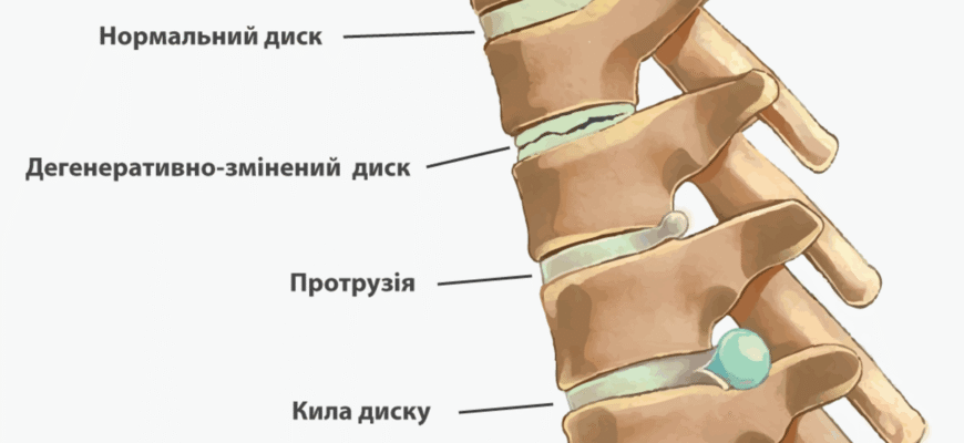 Екструзія диску: причини, симптоми та ефективні методи лікування