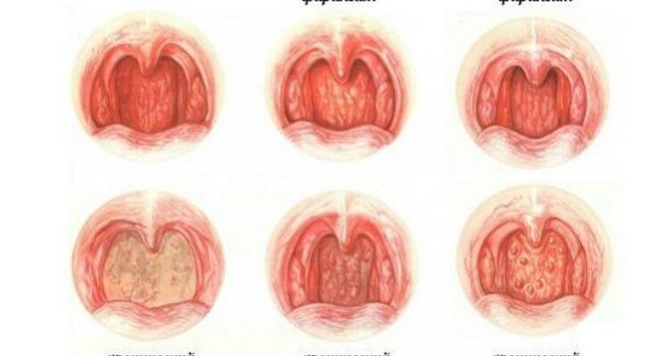 Ларингіт і фарингіт: у чому різниця та як відрізнити захворювання?