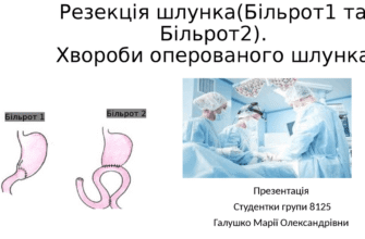 Різниця між процедурами Більрот I і II: що варто знати?