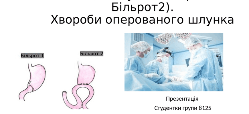 Різниця між процедурами Більрот I і II: що варто знати?