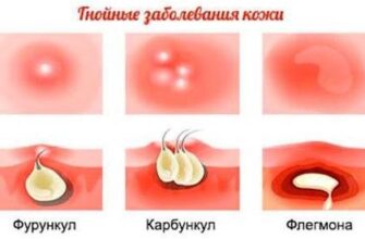Фурункул і карбункул: у чому різниця та як їх розрізняти?