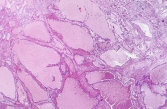 Гемангіома: що це, причини виникнення та методи лікування