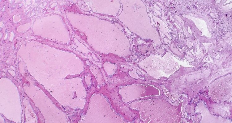 Гемангіома: що це, причини виникнення та методи лікування