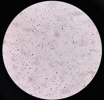 Гіменолепідоз: причини, симптоми та методи лікування паразитарної інфекції