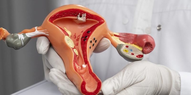 Різниця між кістою та кістомою: симптоми, діагностика, лікування Різниця між кістою та кістомою: симптоми, діагностика, лікування