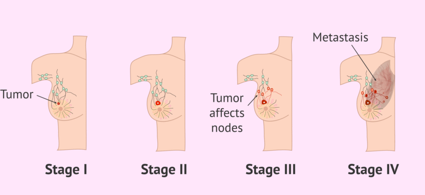 Мамографія: Чи дійсно ця процедура така болюча, як кажуть?