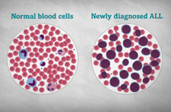 Що таке лейкоз: виявлення, симптоми та методи лікування захворювання