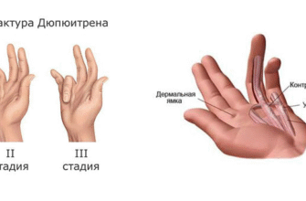 Контрактури: що це таке, причини виникнення та методи лікування