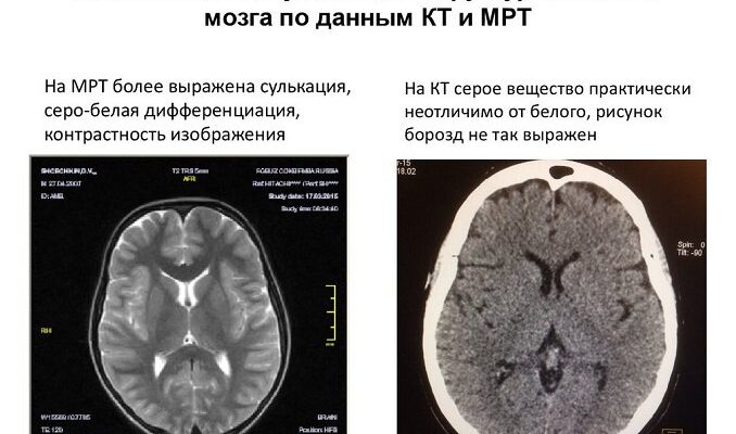 Різниця між КТ та МРТ: Як обрати правильний метод діагностики?