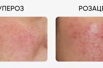 Купероз і розацеа: в чому різниця і як відрізнити симптоми?