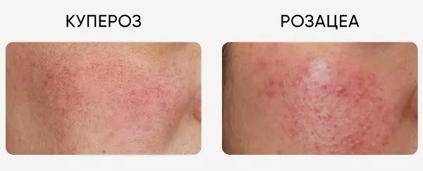 Купероз і розацеа: в чому різниця і як відрізнити симптоми?