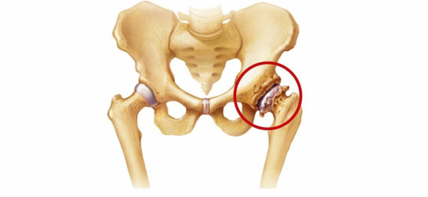 Що таке плоскостопість 2 ступеня: симптоми та лікування проявів