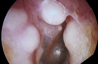 Остеома: що це таке, як діагностувати та лікувати захворювання?