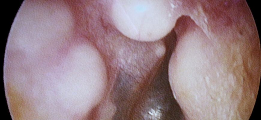 Остеома: що це таке, як діагностувати та лікувати захворювання?