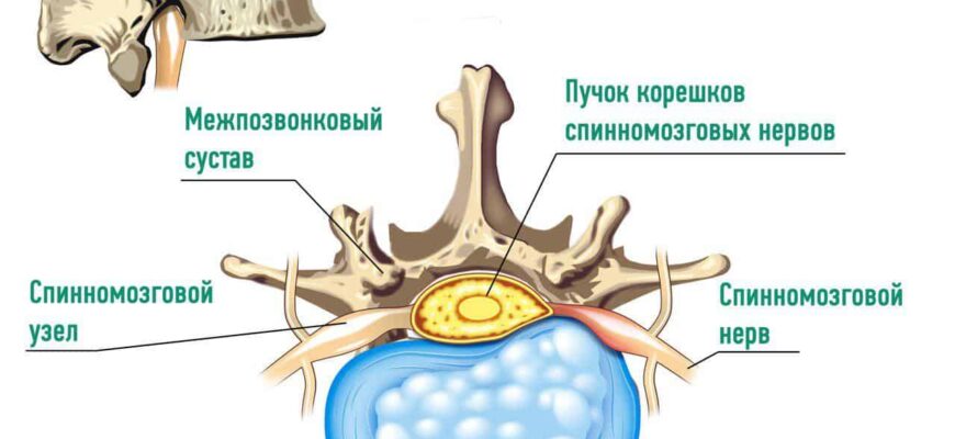 Компресія дурального мішка: причини, симптоми та лікування ефективно