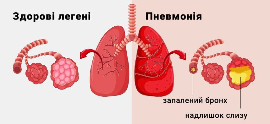 Запалення легень і пневмонія: в чому різниця між захворюваннями?
