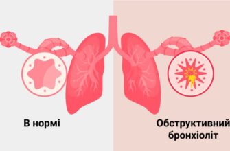 Бронхіт і бронхіоліт: ключові відмінності, симптоми та лікування