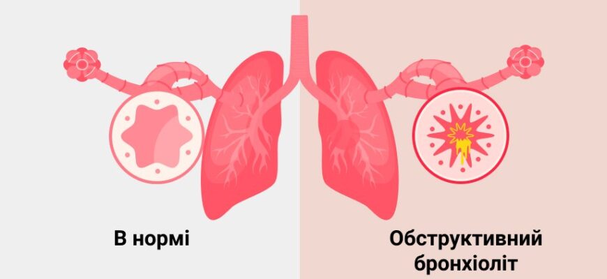 Бронхіт і бронхіоліт: ключові відмінності, симптоми та лікування