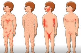 Краснуха і вітрянка: у чому різниця та як відрізнити симптоми?